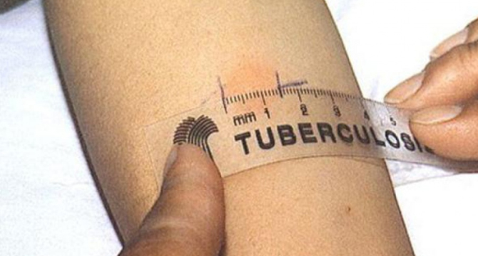 Педиатърът д-р Ваня Пеева: Туберкулозата при децата застрашително се завръща!